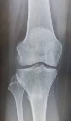 Grade 4 chondromalacia at the patellofemoral joint | Joint Replacement