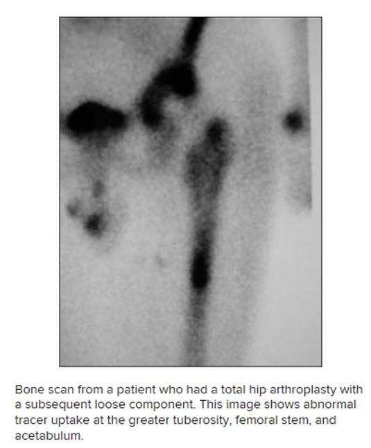 Bone scan history.jpg