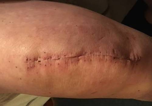 Knee Scars - Post Your Badges of Honor Here! NO CHIT-CHAT please