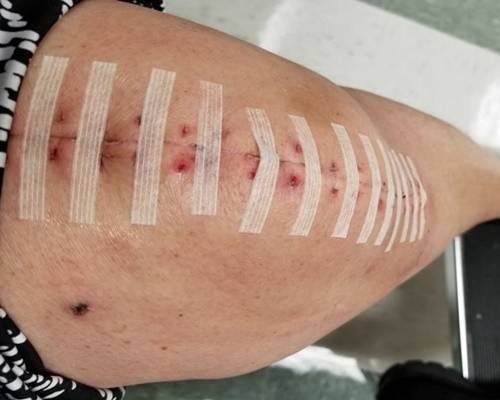 Knee Scars - Post Your Badges of Honor Here! NO CHIT-CHAT please