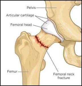 fractured neck of femur.JPG