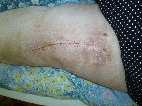 Knee scar.jpg