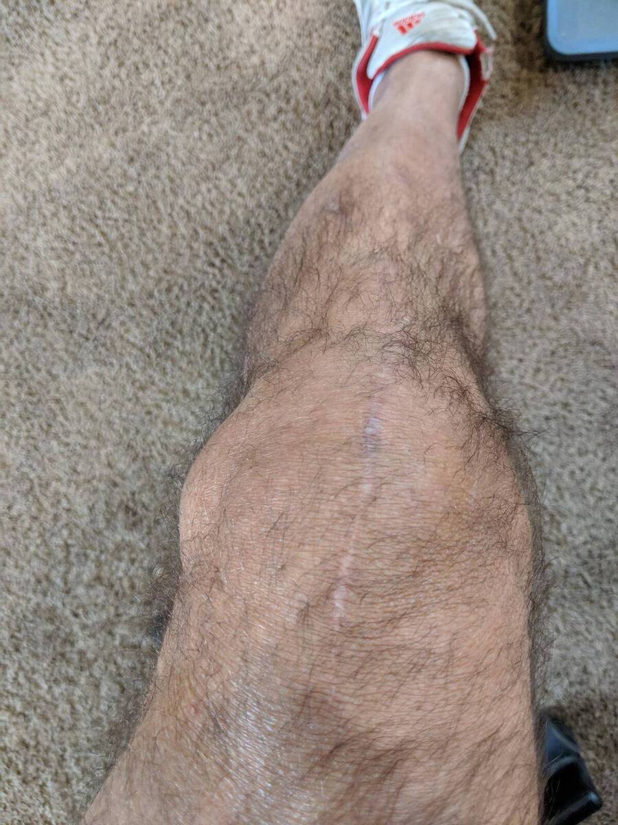 knee swelling.jpg