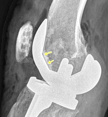 loose femoral implant.jpg