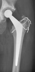 trochanteric osteotomy wiring.jpg