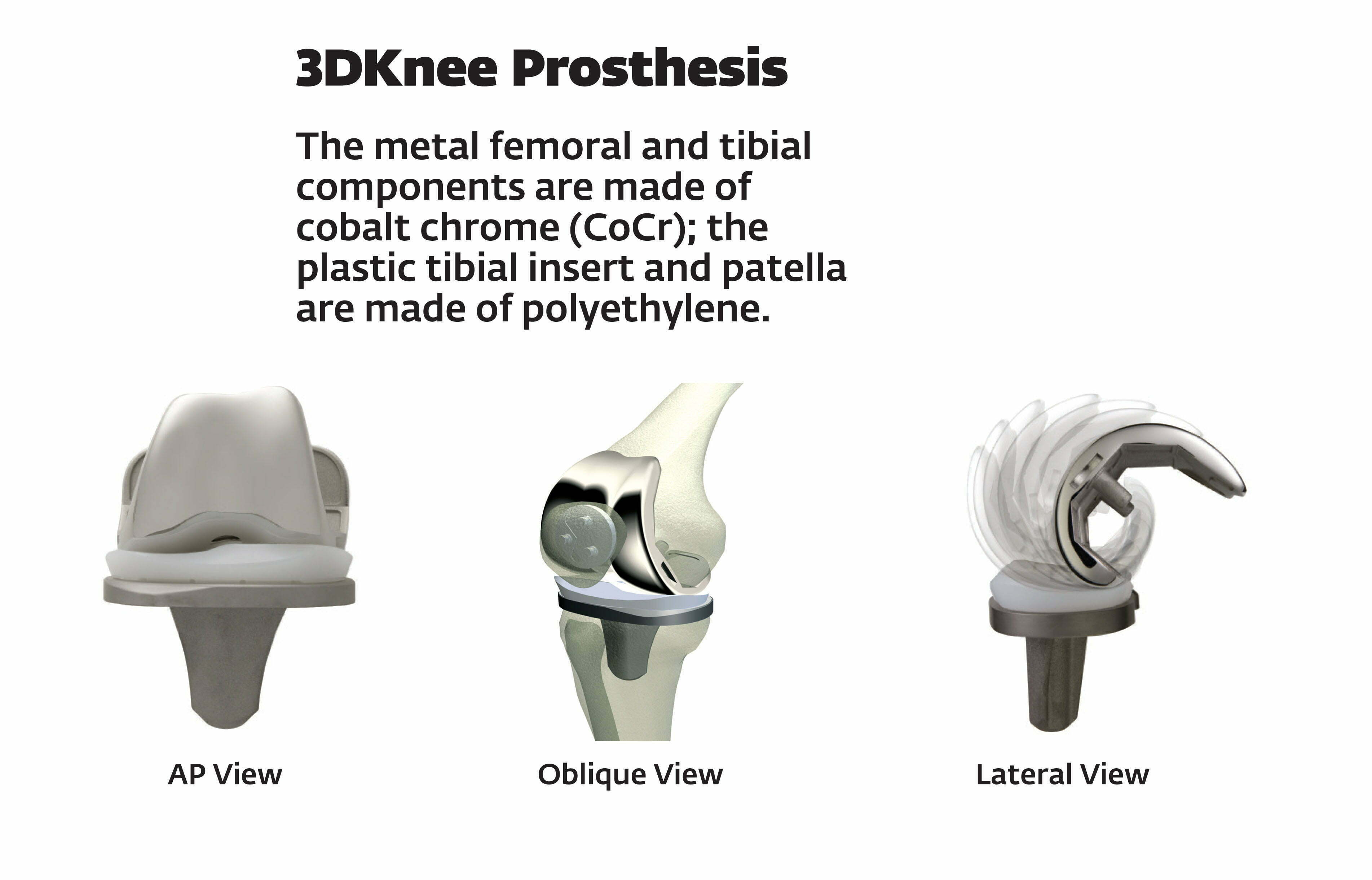 Cobalt chrome knee replacement