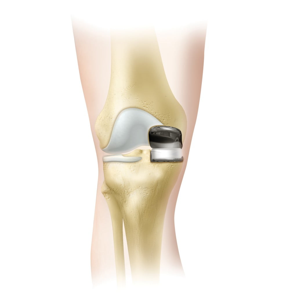 Knee Resurfacing, Partial Knee Replacement Surgery, Operation