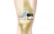 Oxford Knee (Biomet)