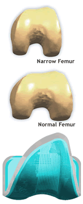 Narrow Femur – Wright Medical