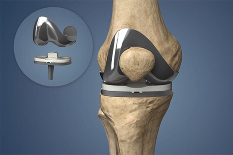 Total Knee Replacement Implants