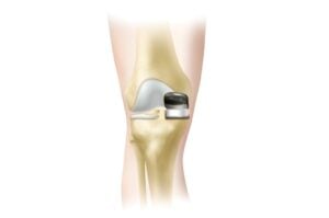 Oxford Knee