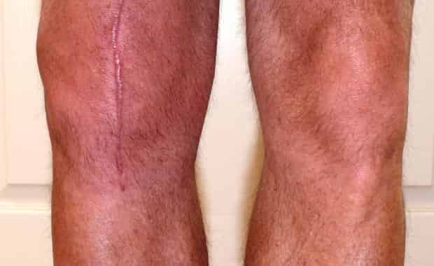 partial knee replacement scar