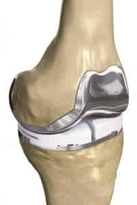 iTotal® Patient-Specific Knee Replacement System - ConforMIS