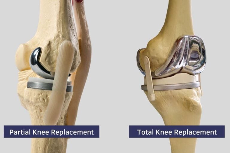 What is the difference between total knee replacement and partial knee replacement?