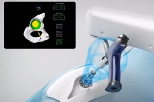 Computer-Assisted Robotic Hip Replacement Surgery