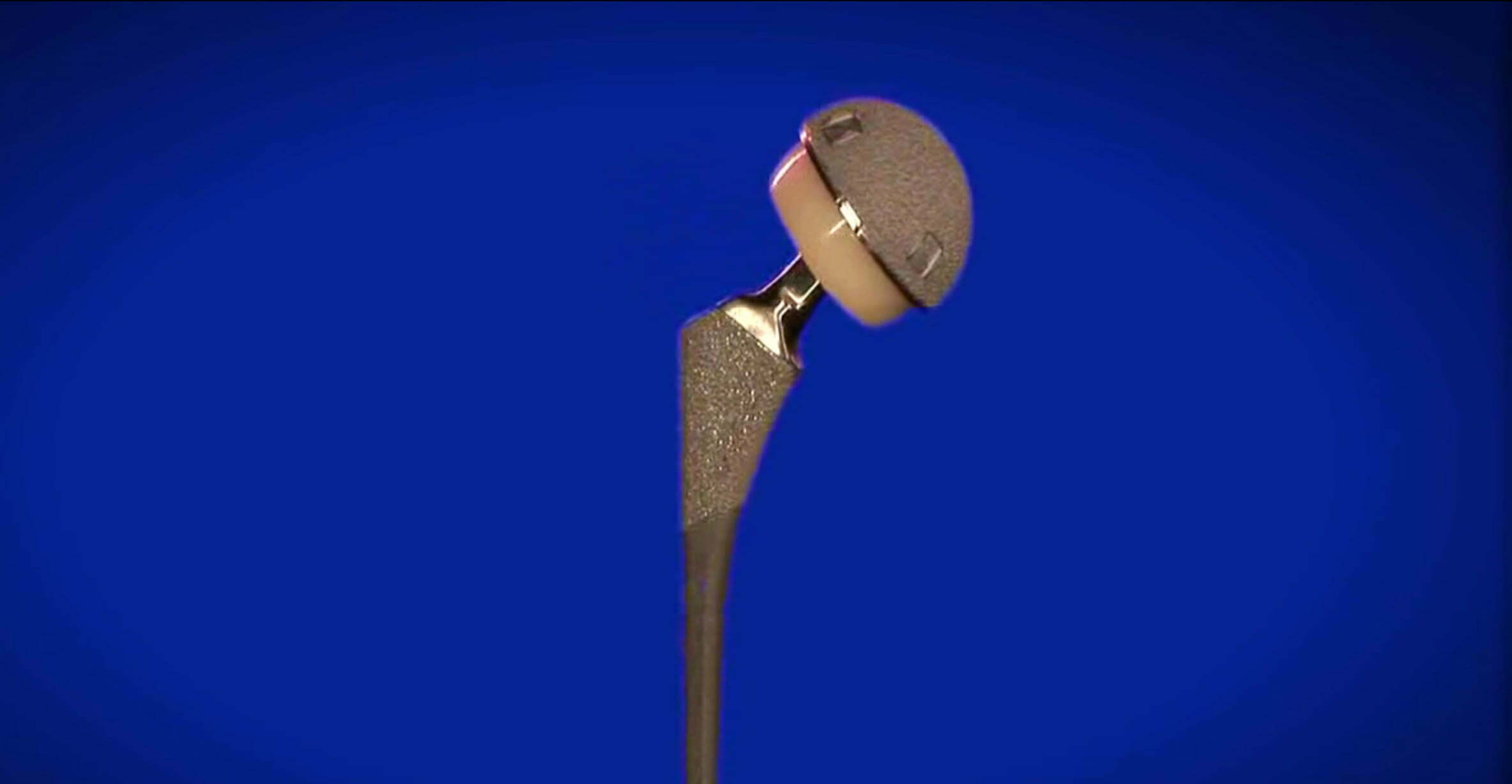 Hip Replacement Implants, Partial, Total, Prosthesis, Prostheses