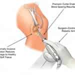 MAKOplasty Partial Knee Resurfacing