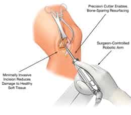 MAKOplasty® Partial Knee Resurfacing (MAKO Surgical)