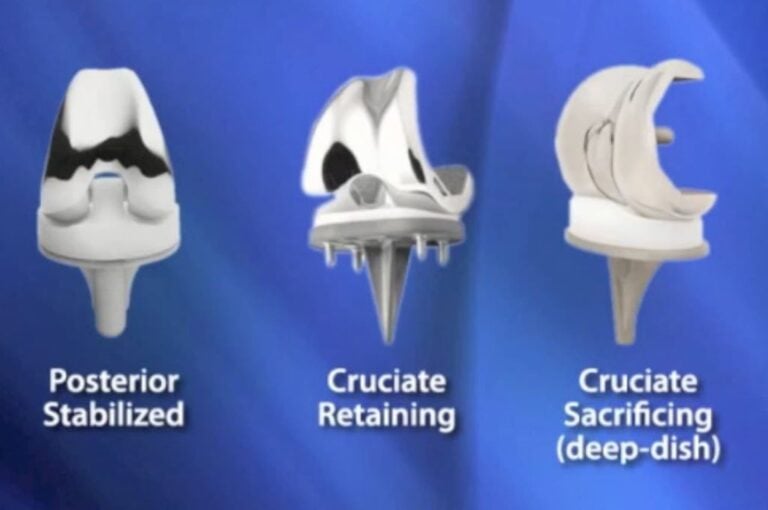 Types of Total Knee Implants