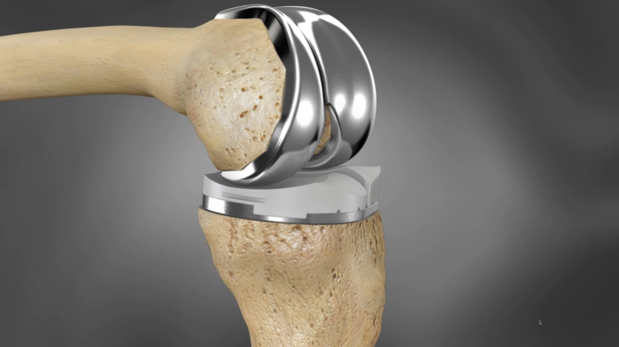 Knee Implants Customized, Personalized & Specialized Options