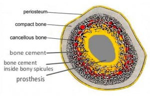 Hip Implant Fixation