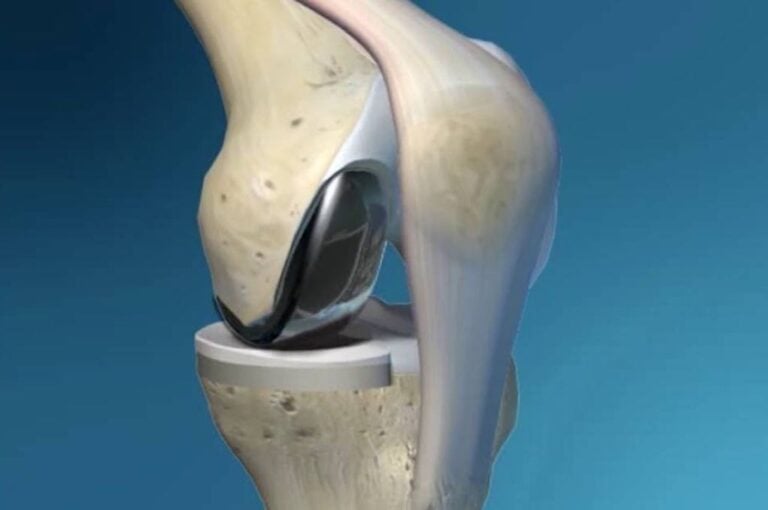 Partial Knee Replacement Implants