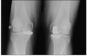 unispacer knee implant