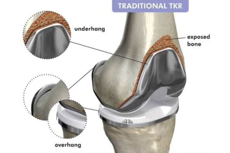 Knee Implants: The Importance of Fit