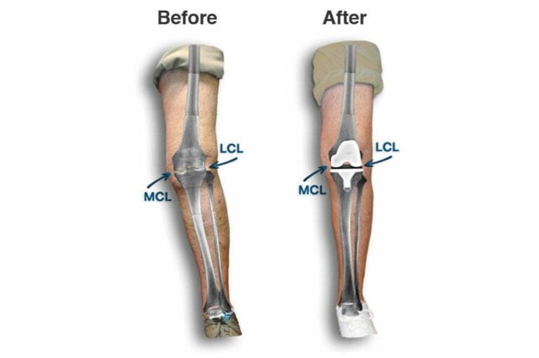 Will my knee be straightened with surgery?