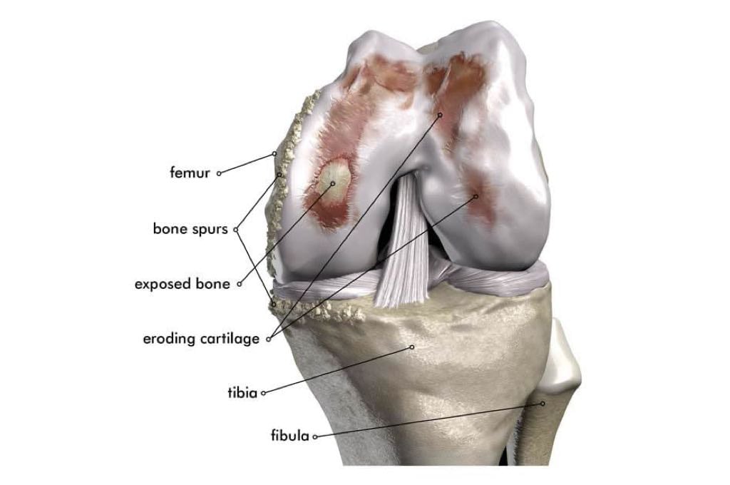 Damaged Knee Joint