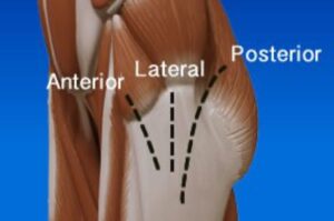 hip replacement incision types