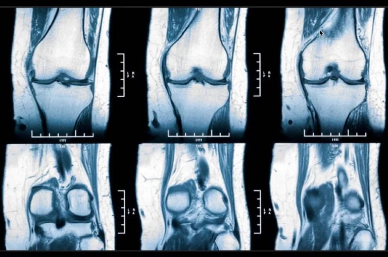 Why Computer Imaging May Be Used Prior To Knee Replacement