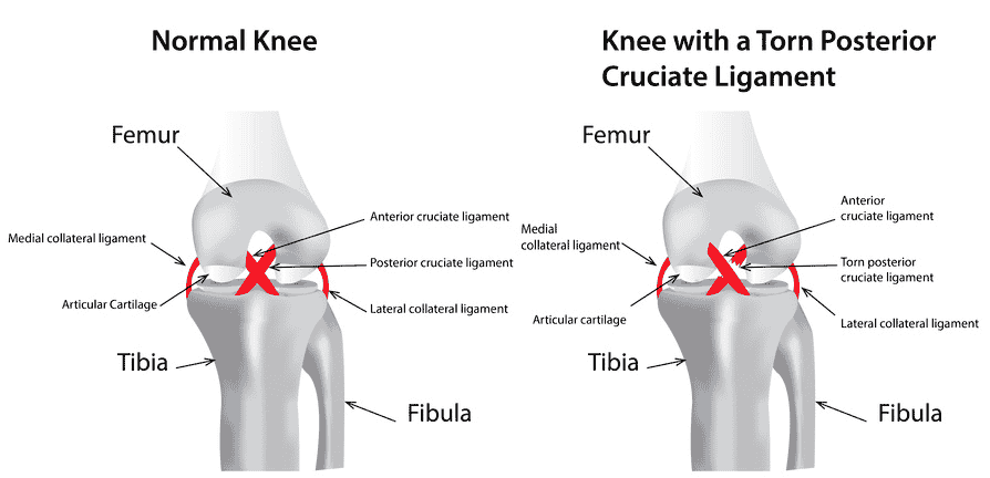 Knee sprains, Torn ligaments