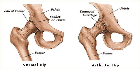 Normal Hip Joint vs. Arthritic Hip Joint