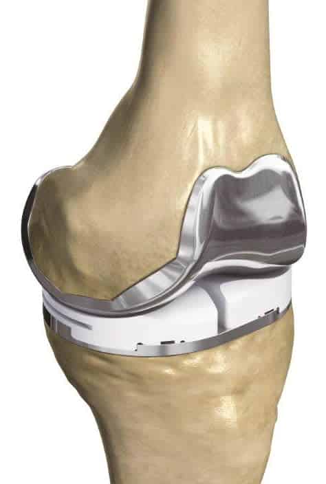 Total Knee Replacement, Precise Fit (image courtesy of ConforMIS)