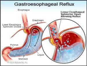 nsaids gastroesophageal reflux